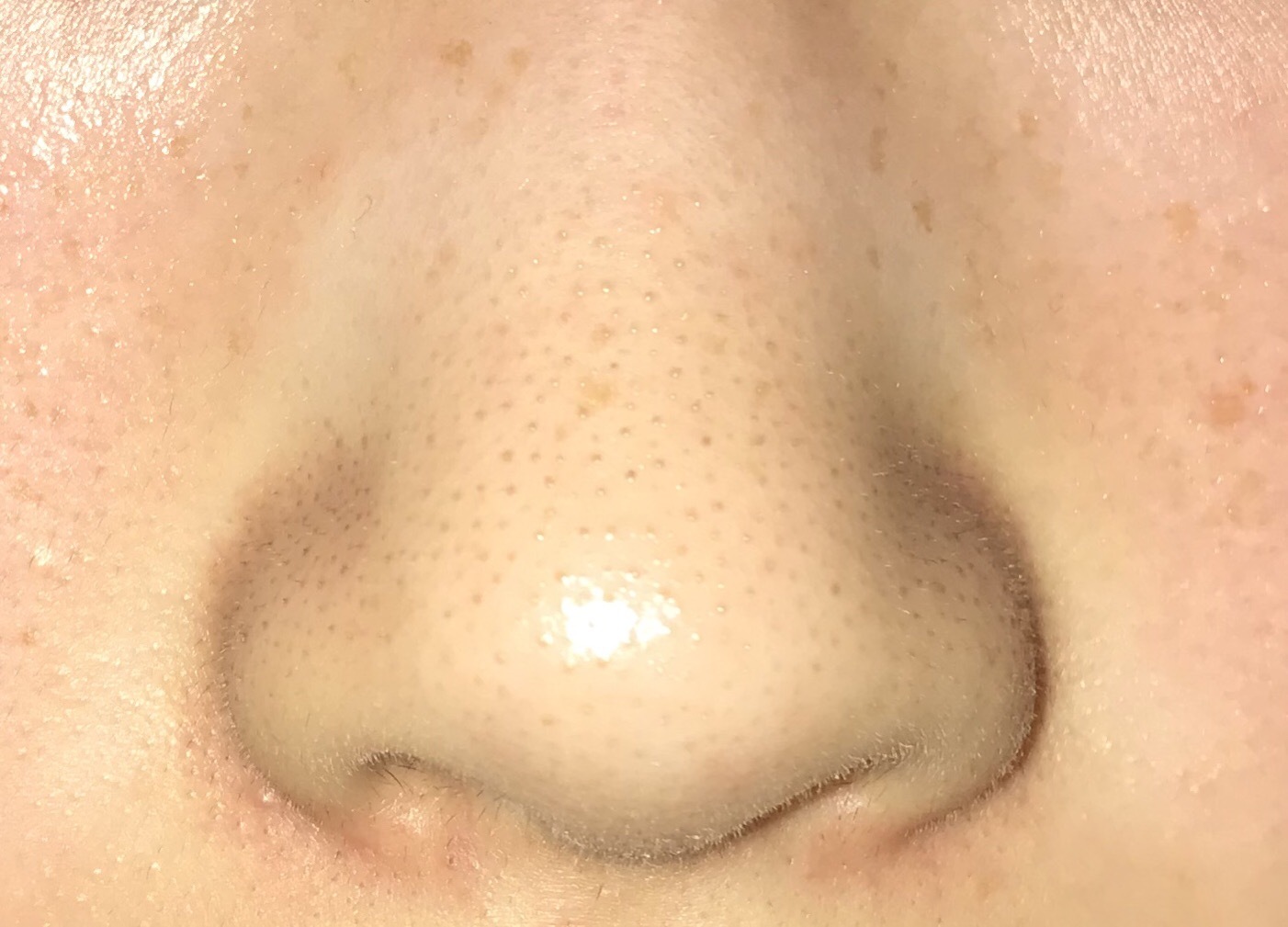 鼻の黒ずみ 角栓 毛の処理について 写真で見てわかる通り Q A Cosme アットコスメ