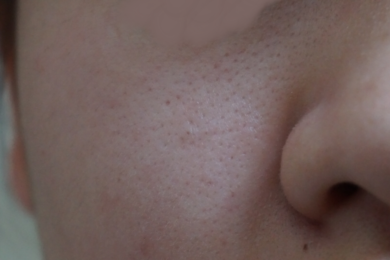 鼻の横 目の下の毛穴の開き 脂性肌で少し敏感肌の高校生で Q A Cosme アットコスメ