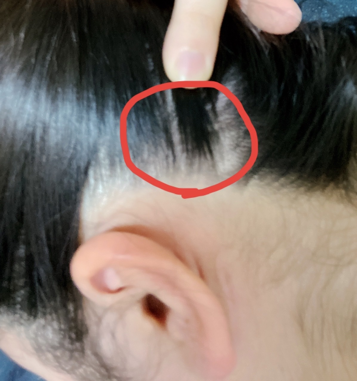 右耳の後ろの髪の生え際辺りにたんこぶのような腫れ タイト Q A Cosme アットコスメ