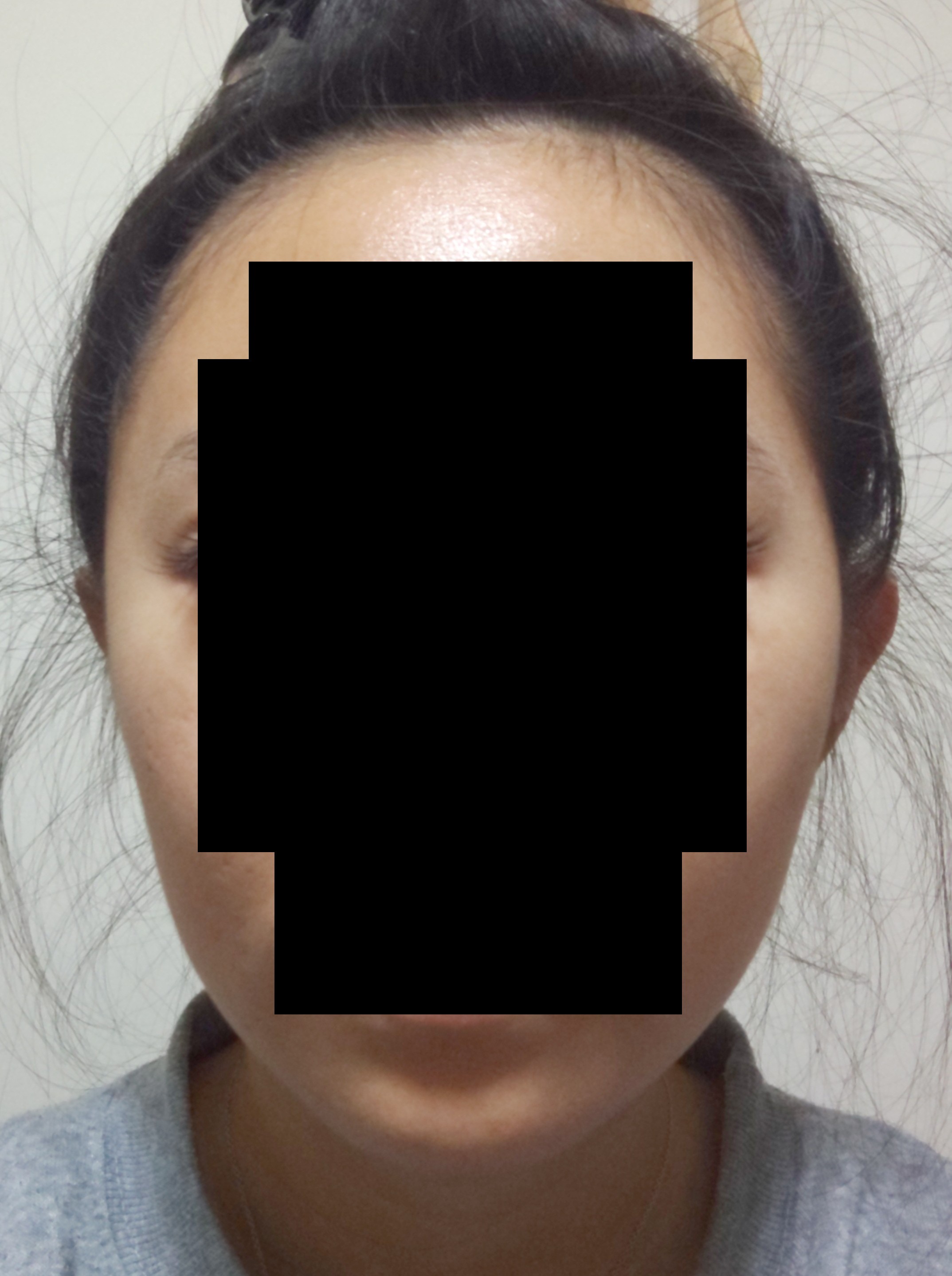 顔の歪みがひどい 歯列矯正でマシになる 元々顔の歪みは Q A Cosme アットコスメ