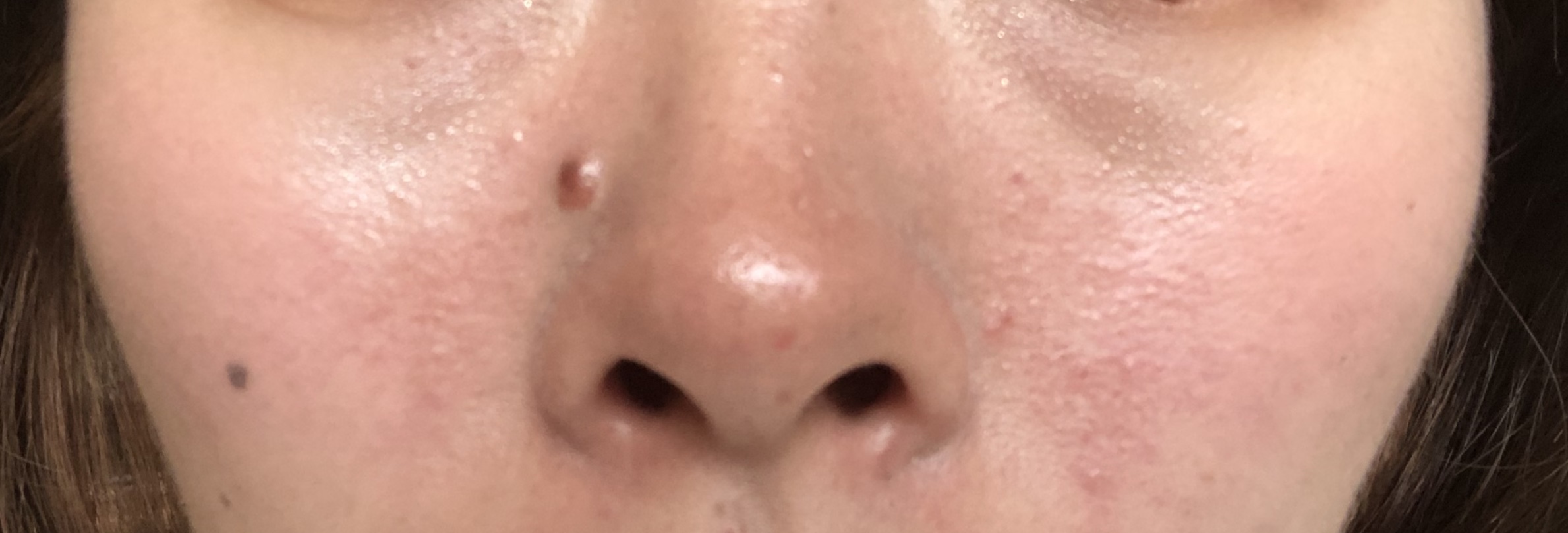 ずっとずっと悩んでいるいちご鼻と赤みについて（写真付き）by くろしばけんさんの画像