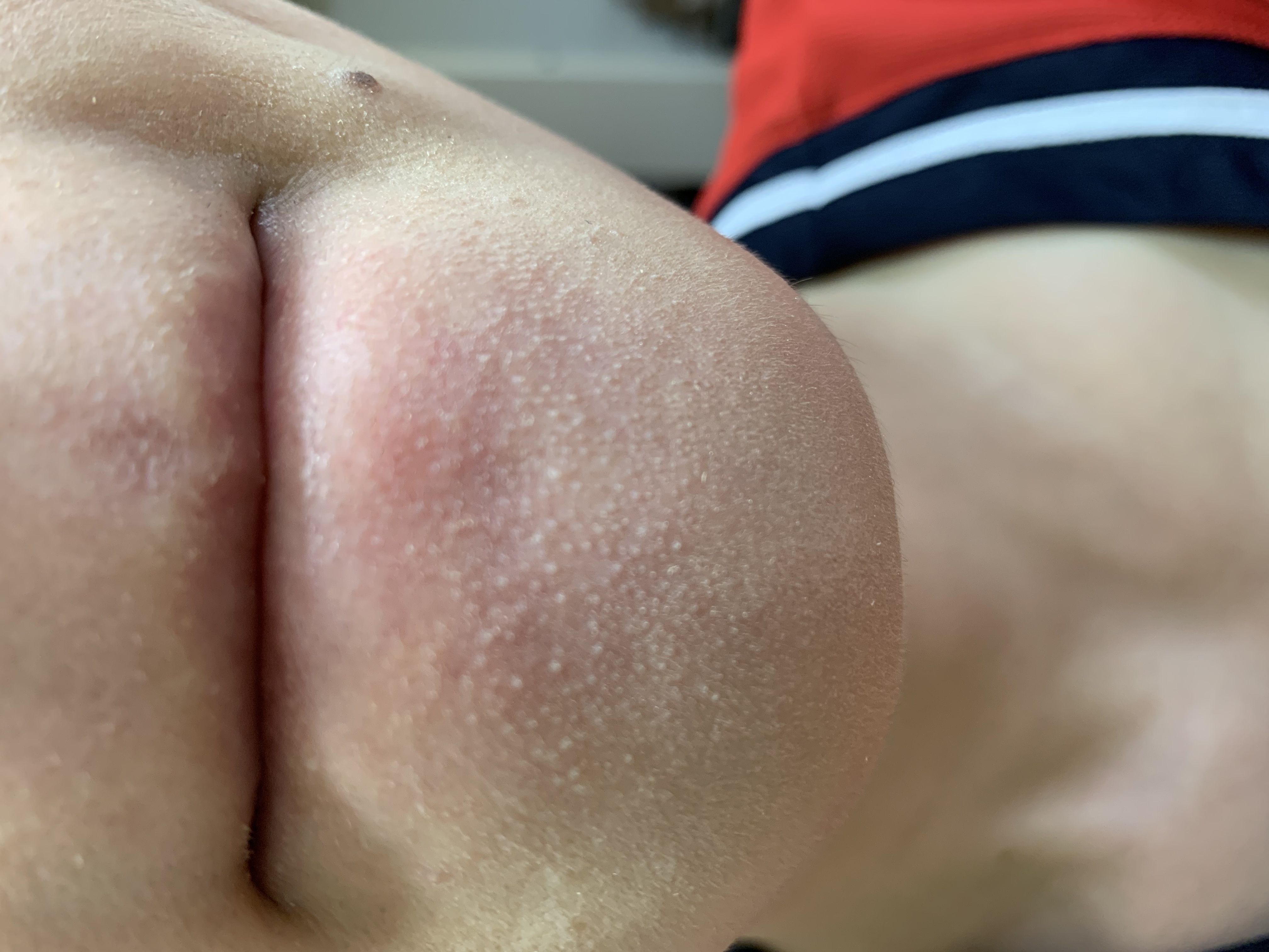 鼻、口周りの角栓について（写真あり） by ちょりKさん の画像