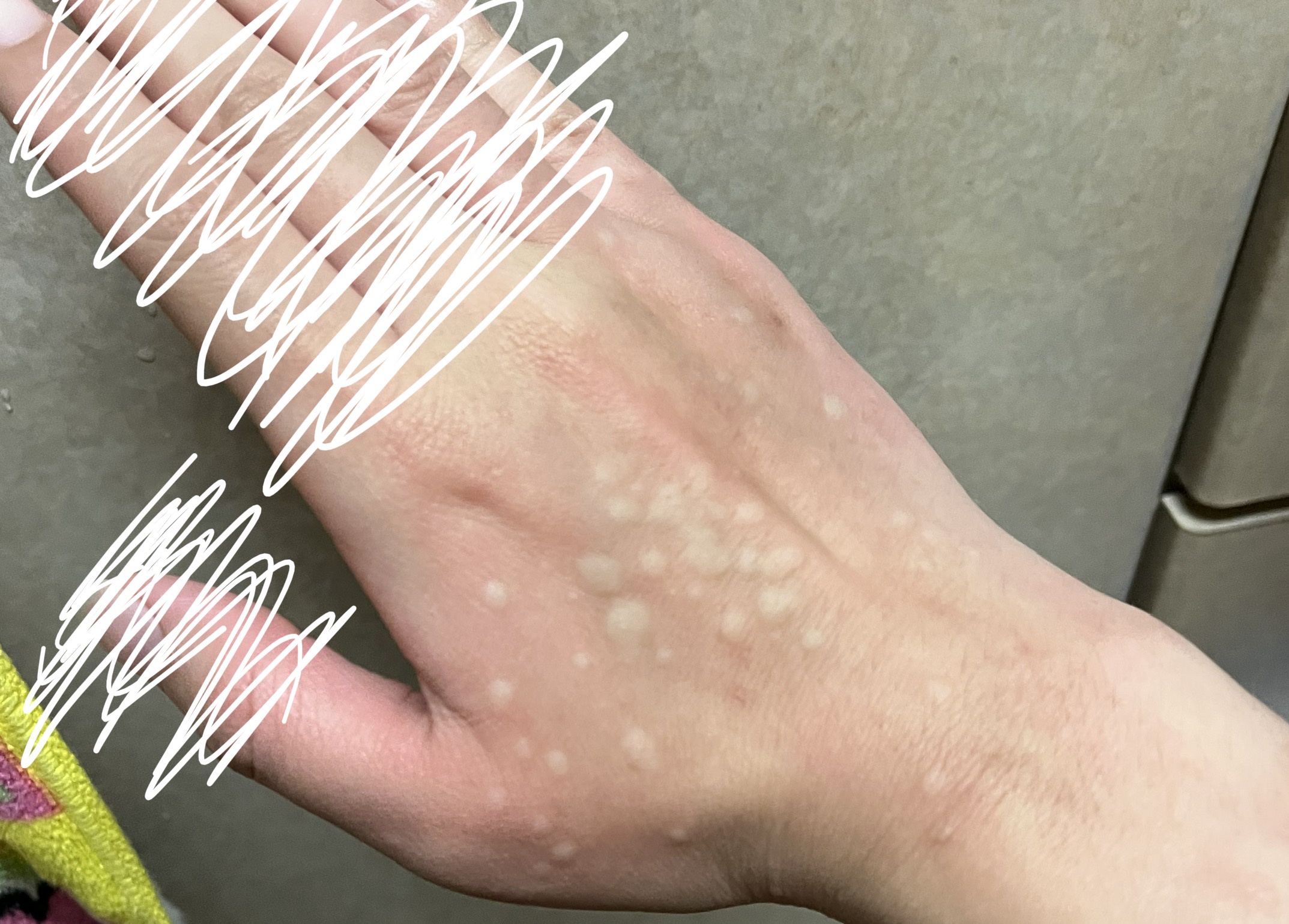 手の甲 ぶつぶつ ブツブツby み^_^さんの画像