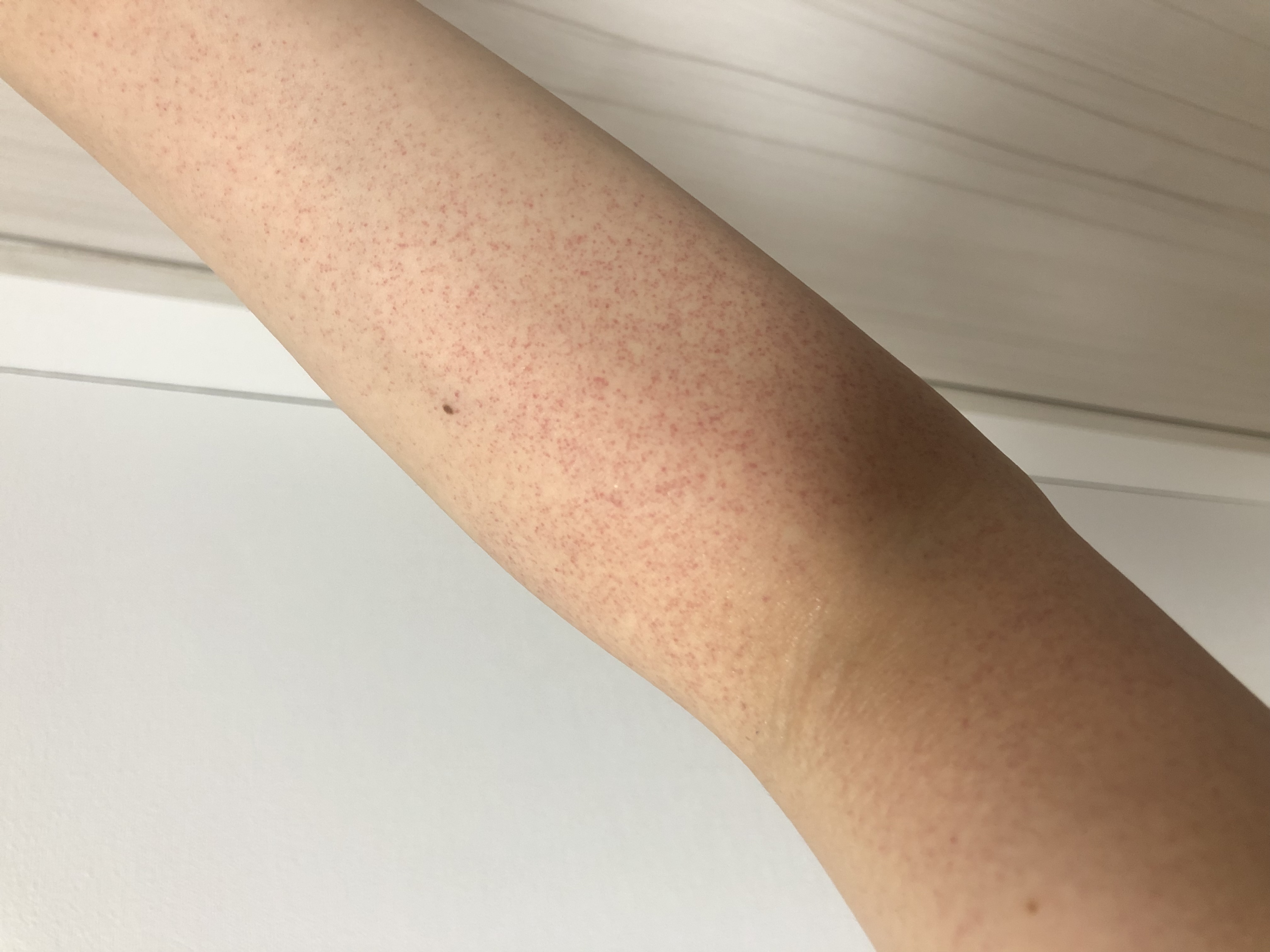 湿疹 被れ 皮膚炎 腕足がたまに写真様に赤くなります Q A Cosme アットコスメ