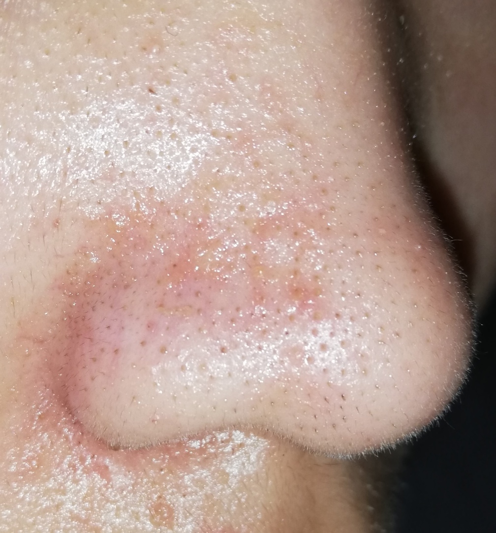 小鼻の赤み いちご鼻 脂漏性湿疹 鼻のスキンケアを教えて Q A Cosme アットコスメ
