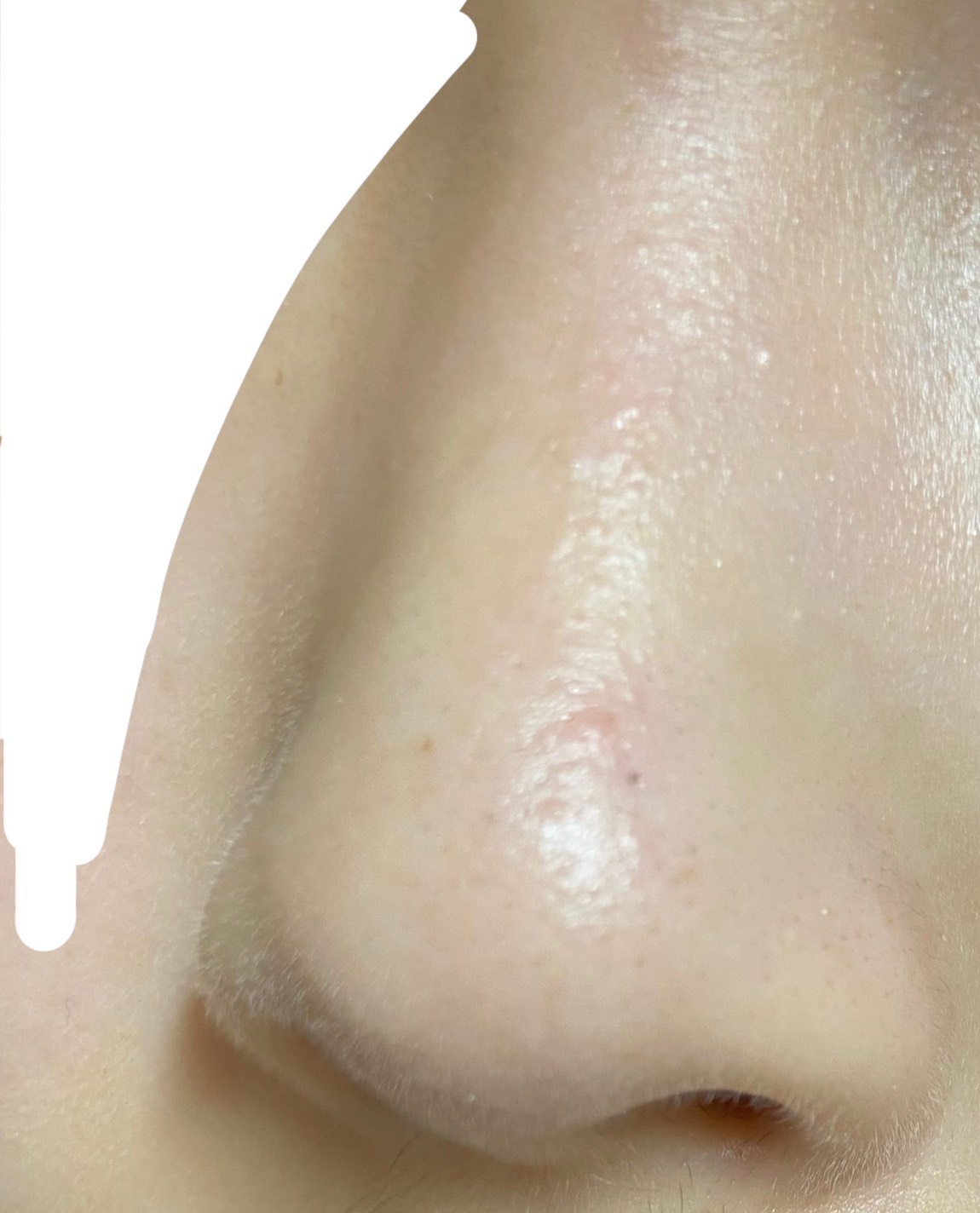 いちご鼻改善のq A一覧 美容 化粧品情報はアットコスメ