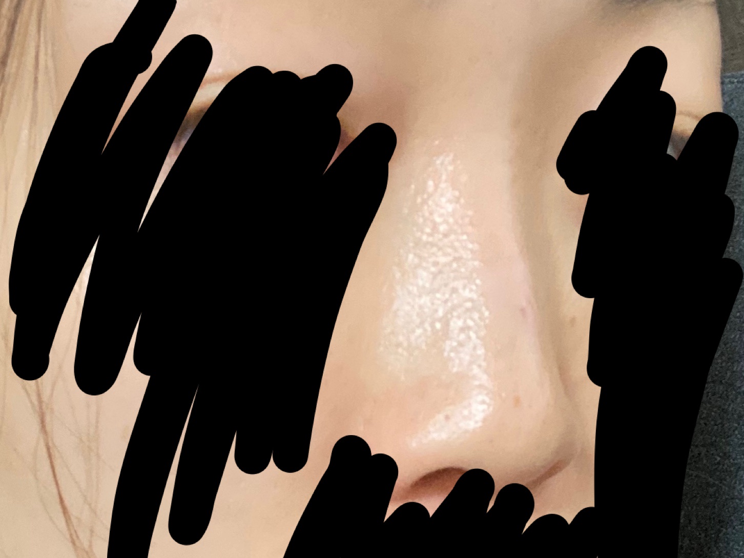 【新】鼻筋横のブツブツ by 匿名さん の画像
