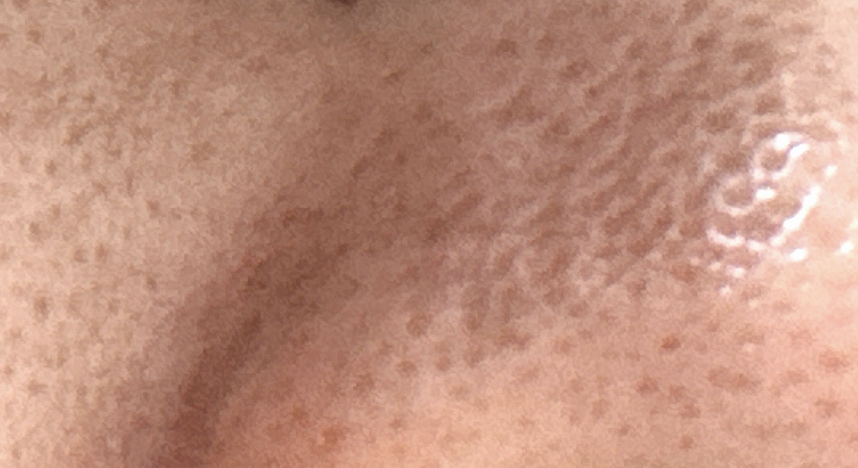 鼻の毛穴開きについてby 匿名さんの画像