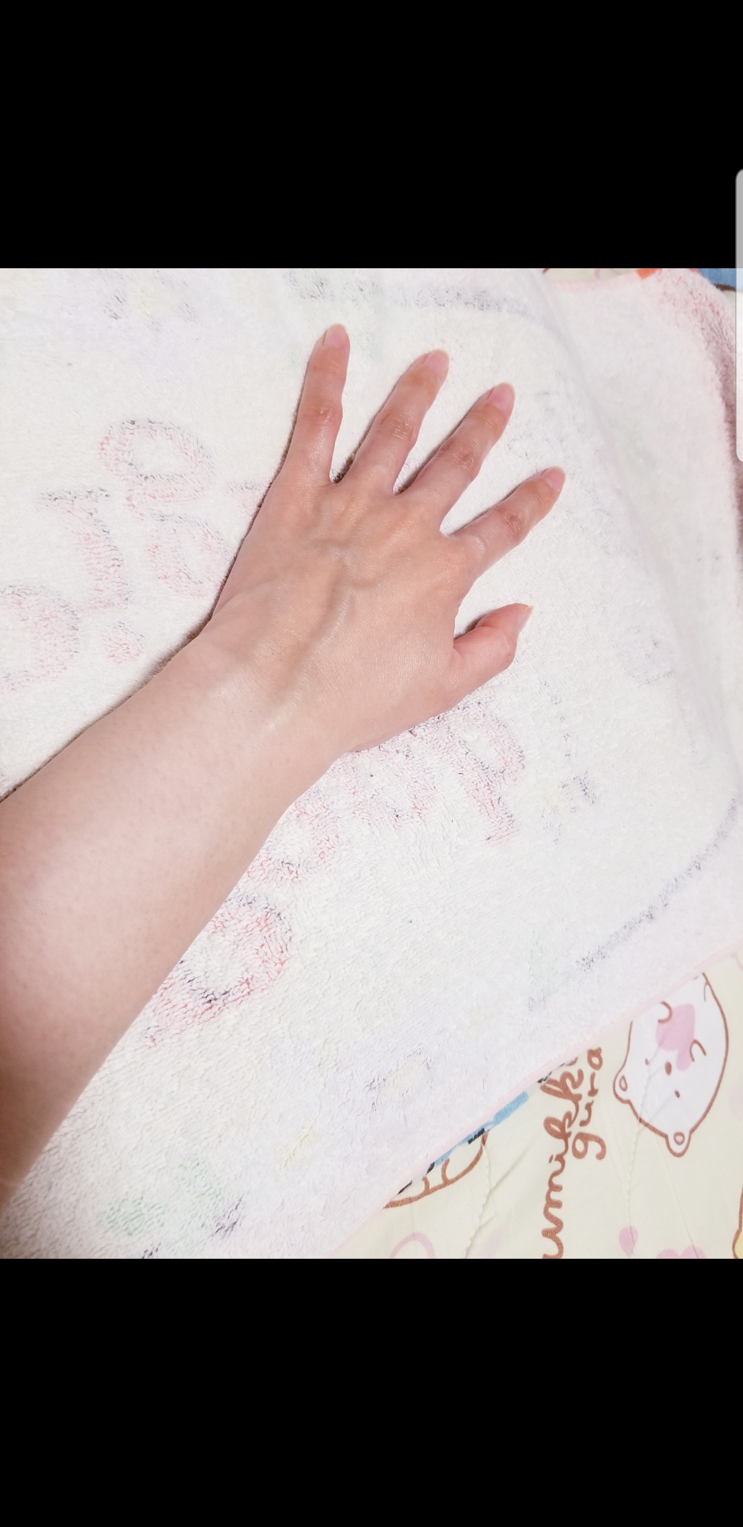 手の甲の日焼け？黒ずみ？について。by *yumaru*さんの画像