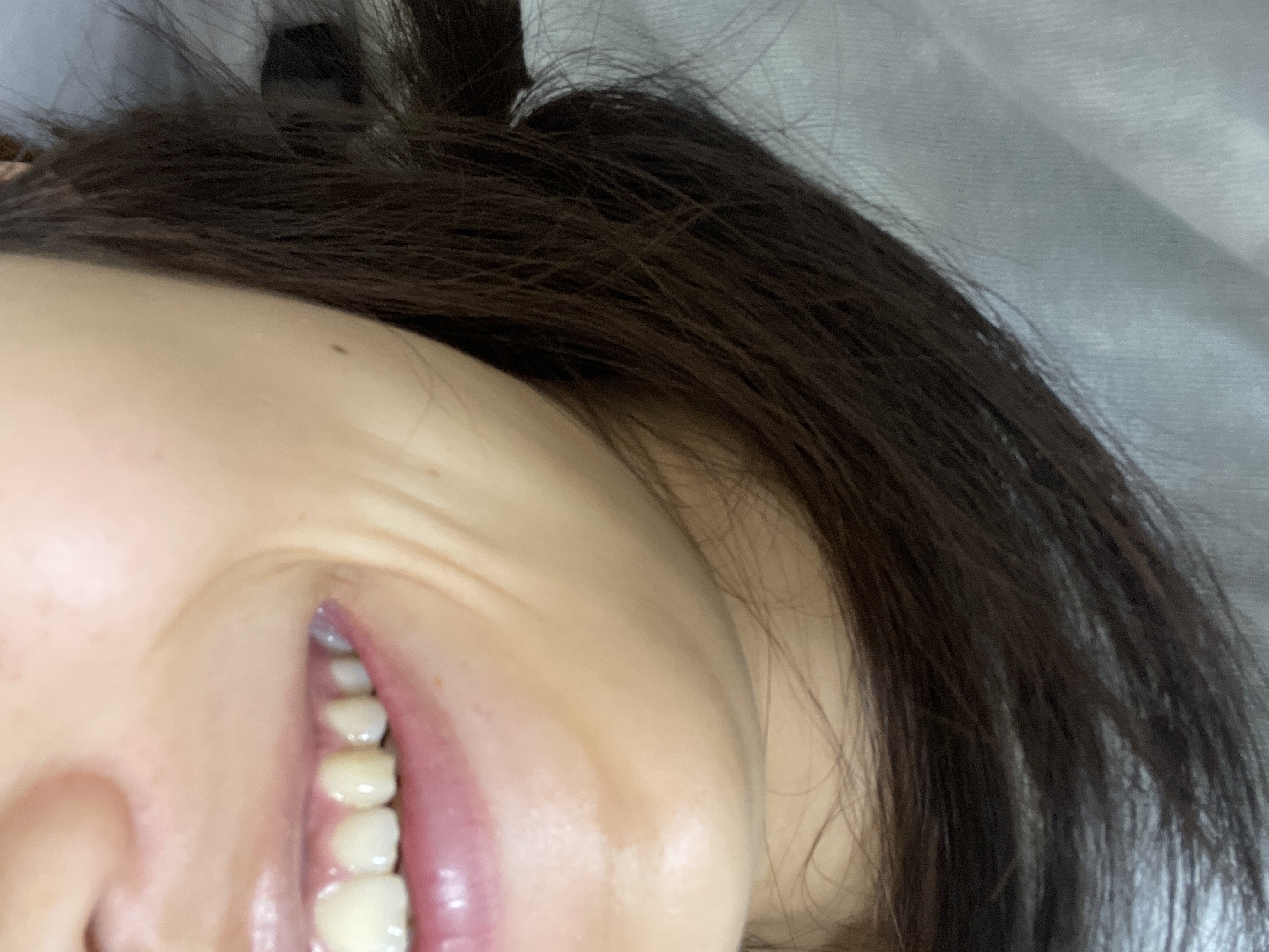 ほうれい線の横にある縦線についてby shiroka1206aさんの画像