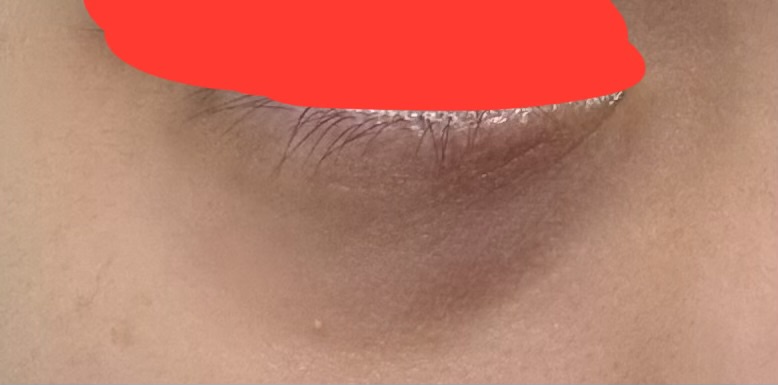 10代クマで悩んでいます…by m1277さんの画像