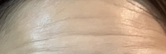 おでこのシワby 匿名さんの画像