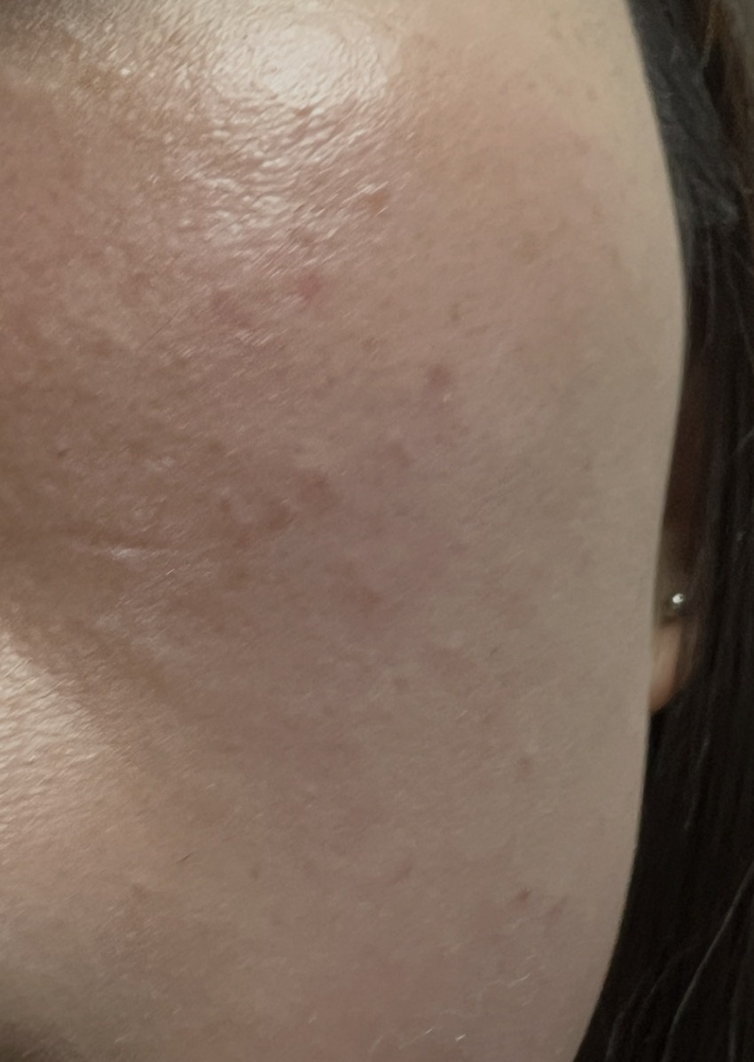 ニキビby 涅7788さんの画像