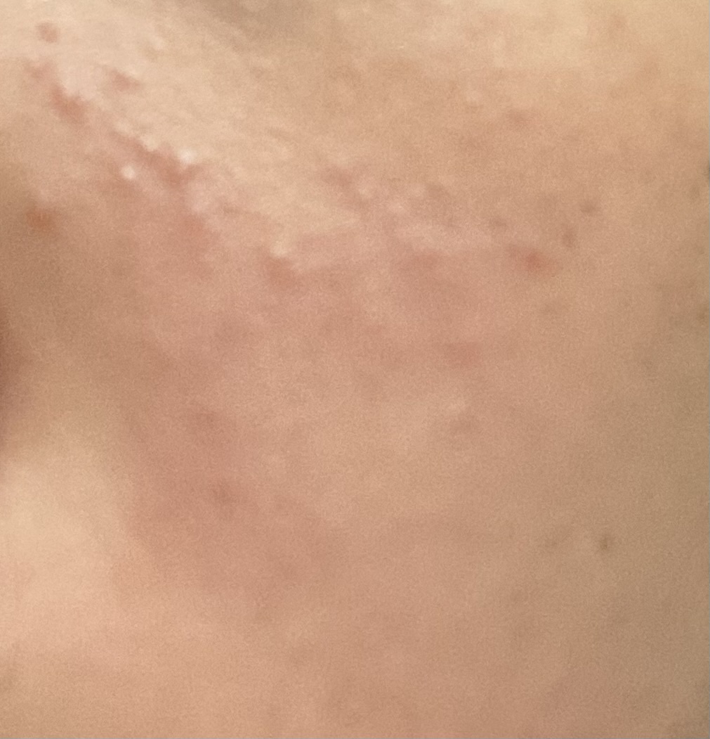 ニキビby ブリー3361さんの画像