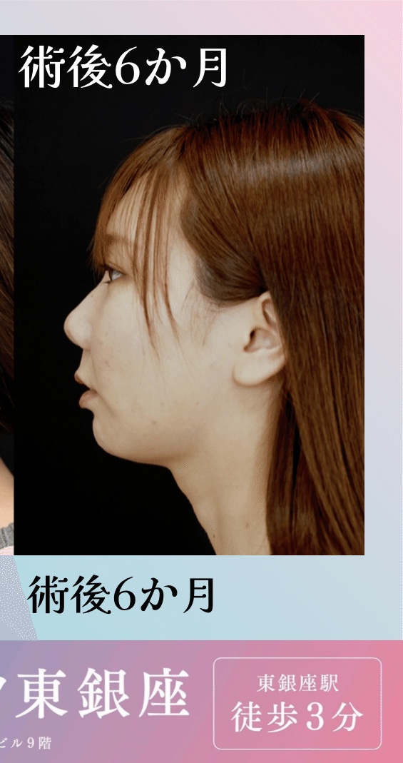 顎変形症 歯列矯正 by あ4342さん の画像