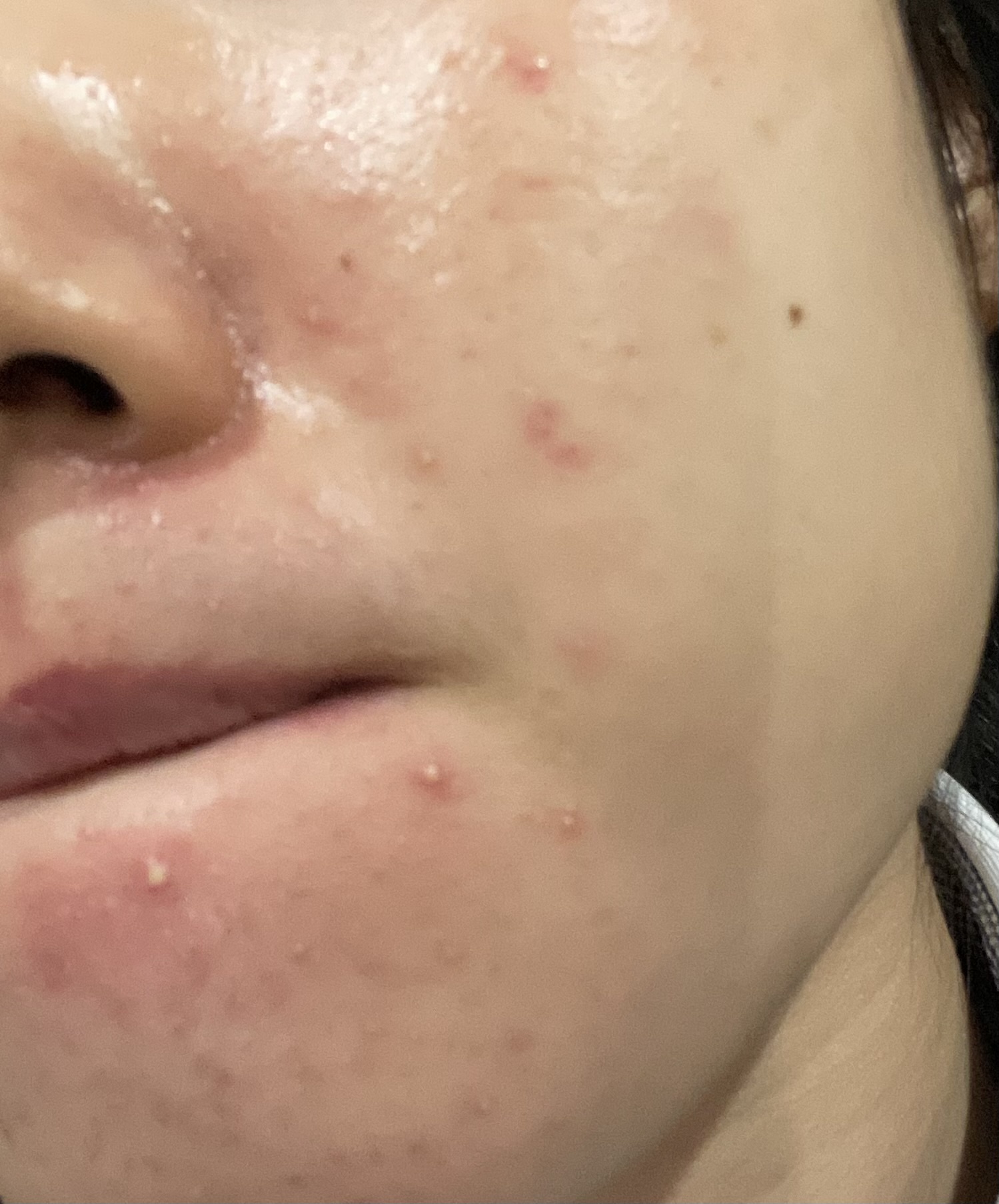 肌荒れby ばっ2343さんの画像