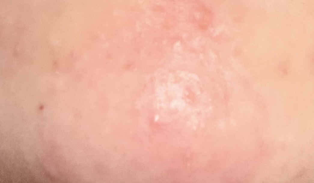 閲覧注意 高校生で美容医療したいのはおかしいですか? by 匿名さん の画像