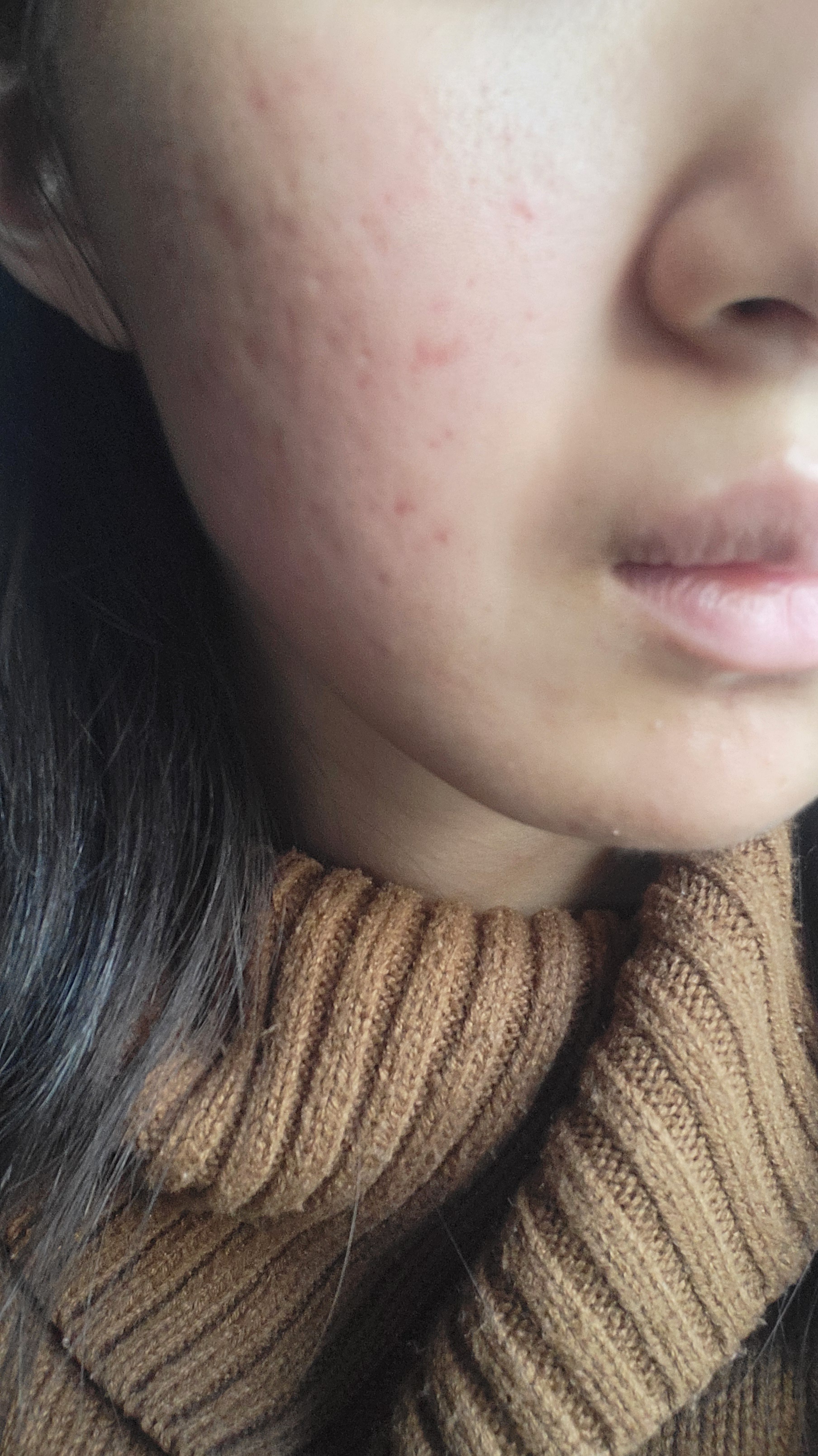 毛穴が目立って、ほうれい線が酷くニキビも治りにくいです。 by Asumi0835さん の画像