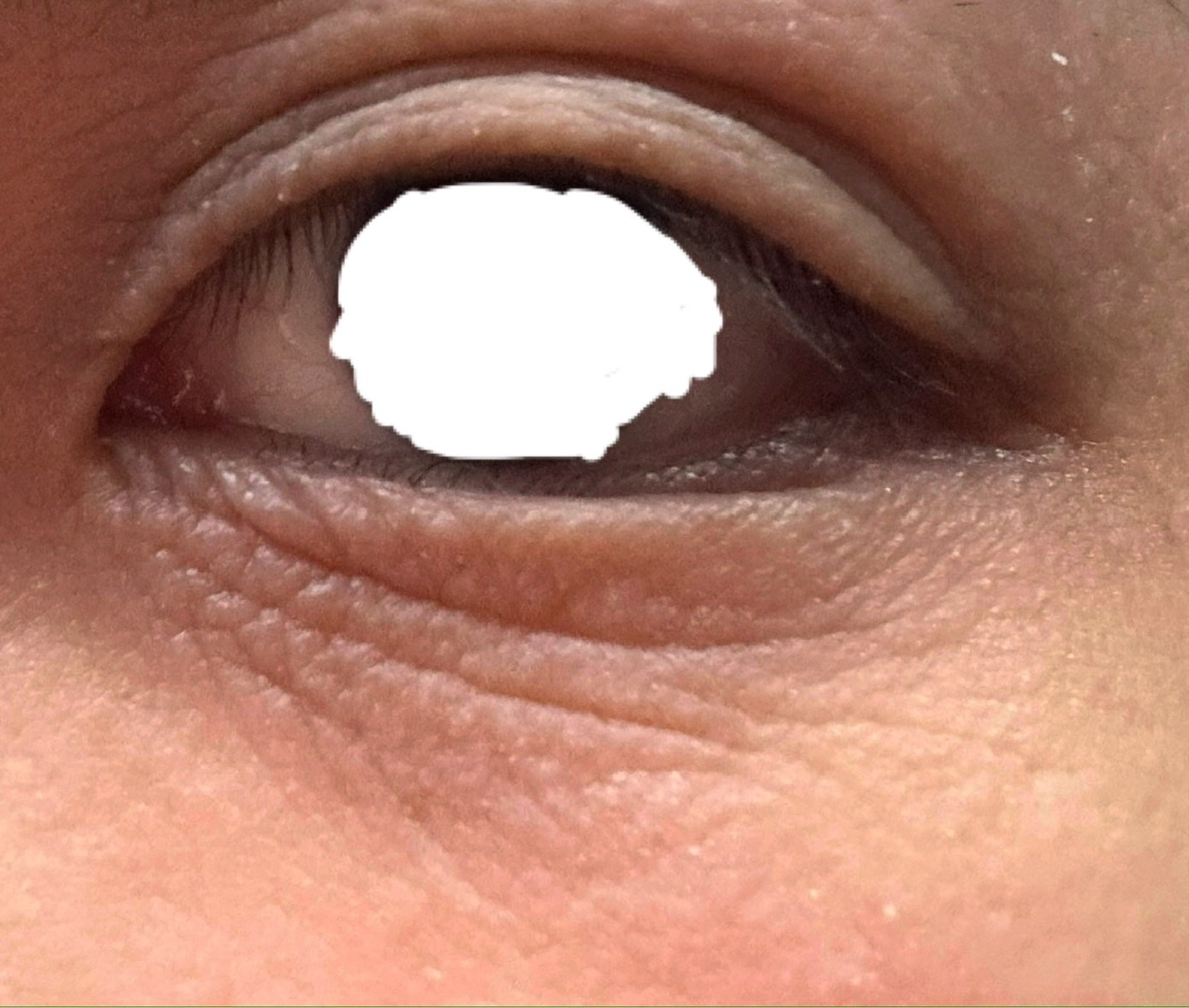 �c��������̃A�g�s�[�ł̖ڂ̉��̃V���E�F�f�����̉��P���@�ɂ��ċ����Ă��������Iby ����4802����̉摜