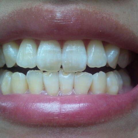 歯を白くしたいです 画像あり 全体的に黄色いです Q A Cosme アットコスメ