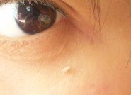 眼の下に出来た皮膚の固まりのようなできもの に悩んでいま Q A Cosme アットコスメ