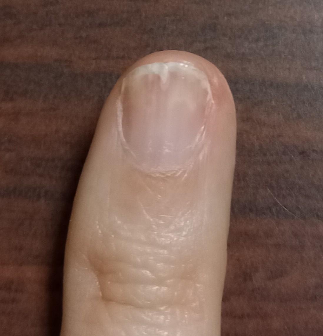 小指の爪の亀裂、どうすればいいでしょうか？ by 匿名さん の画像