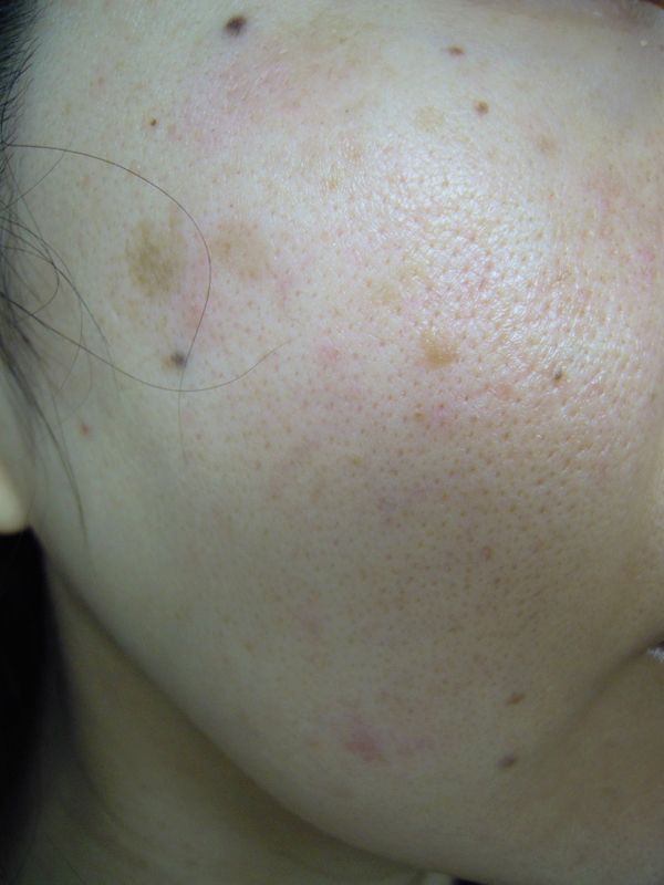 頬の赤み 毛穴 皮脂 炎症 化粧品による炎症 最近 頬 Q A Cosme アットコスメ