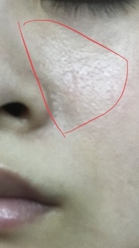 顔のブツブツ 今年の2月ぐらいから 顔の中心に細かく毛穴 Q A Cosme アットコスメ
