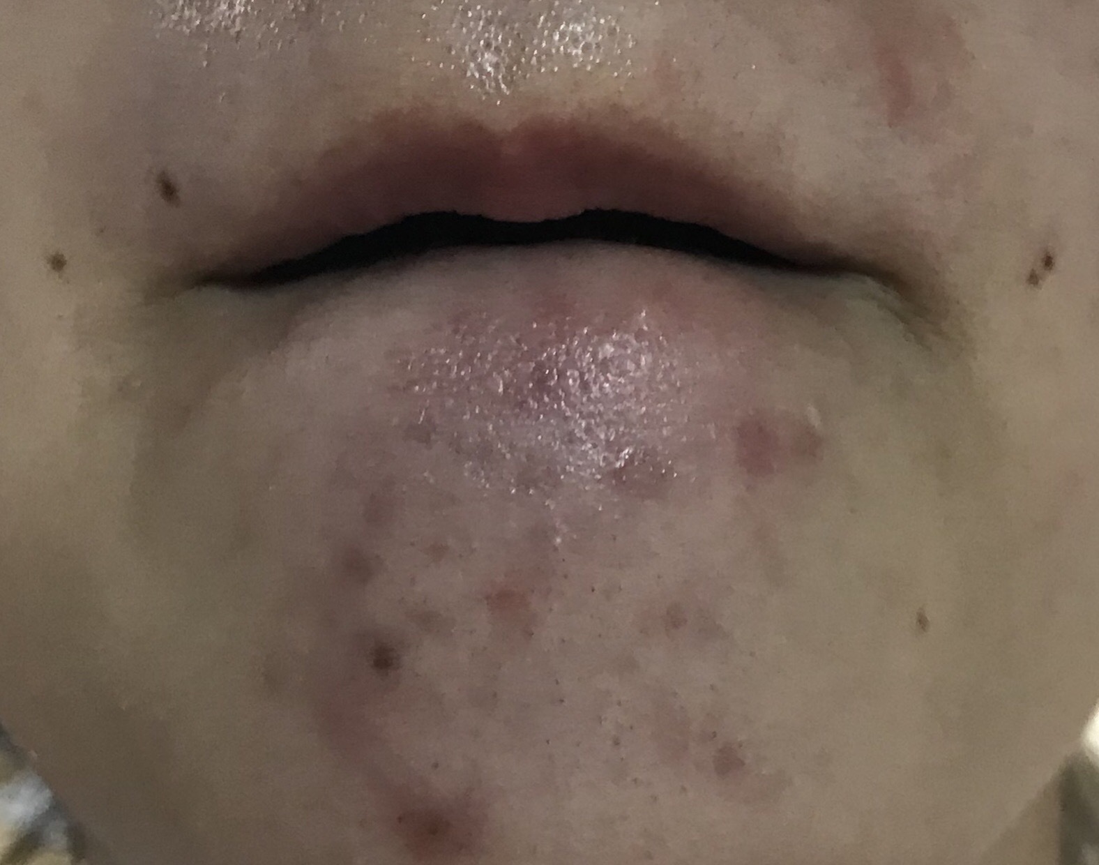 顎ニキビ 鼻周りの赤みがひどいです 汚い写真つきですみ Q A Cosme アットコスメ